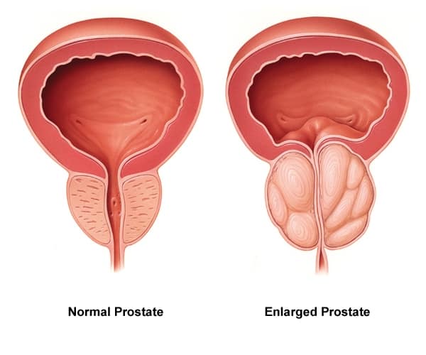 Lehet- e vörösség a prostatitisből A fibrózis fókusza a prosztatába