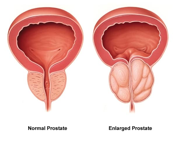 prostatitis zsineg