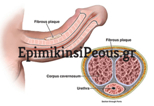 nosos peyronie greece-min